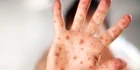 Measles Outbreak Erupts in South Carolina