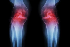 Read more about the article Regenerative Knee Injection Rebuilds Cartilage, Fights Arthritis
