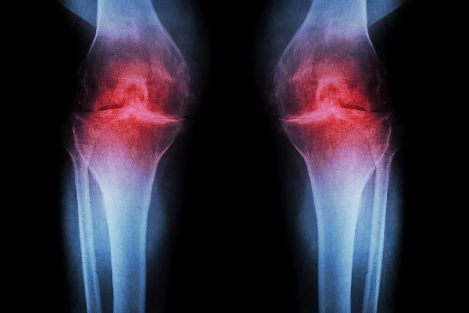 Read more about the article Regenerative Knee Injection Rebuilds Cartilage, Fights Arthritis