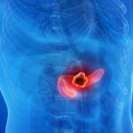 Scientists Achieve Stunning Breakthrough as Triple-Drug Therapy Wipes Out Pancreatic Tumours Without Resistance