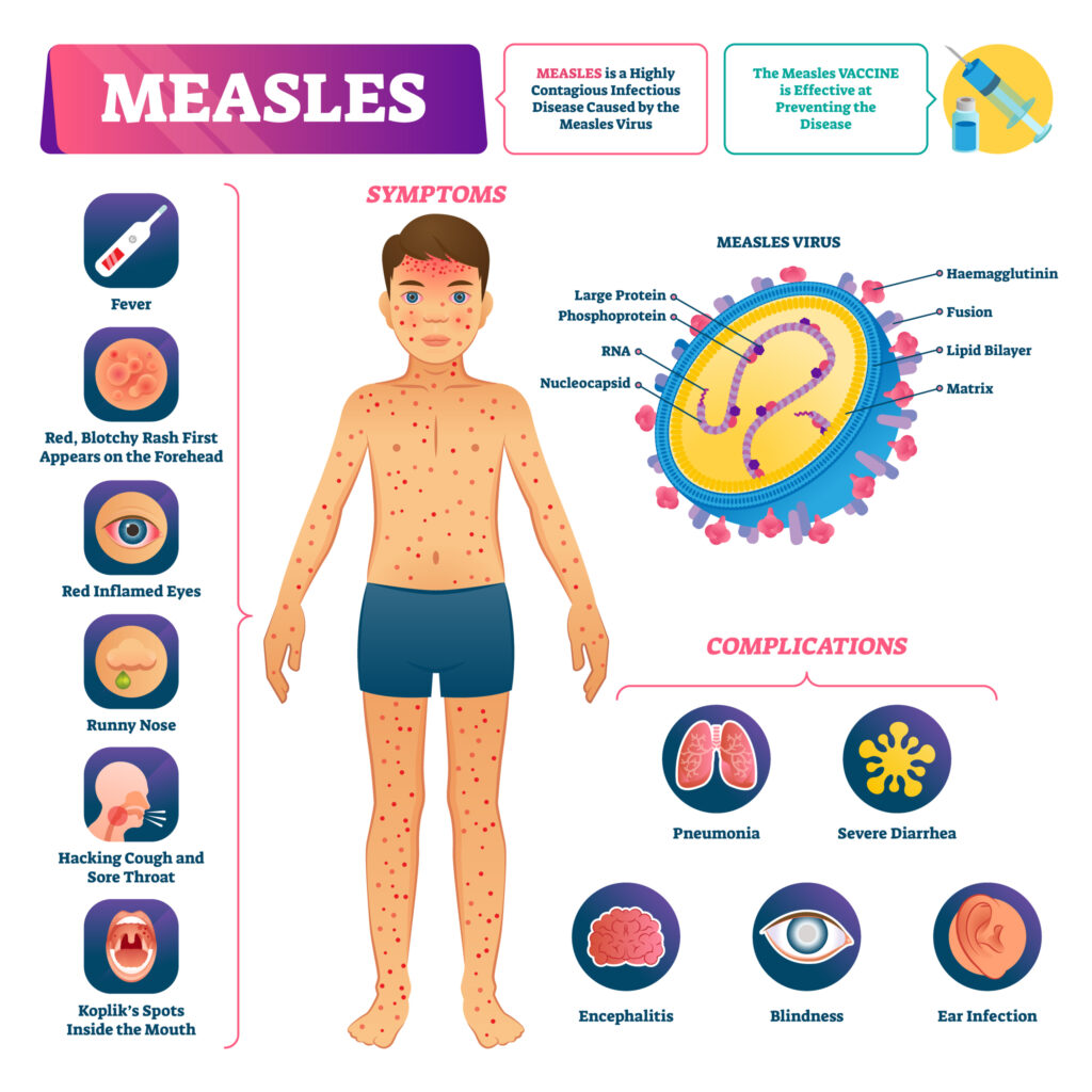 Measles Cases Surge Across the U.S., Raising Urgent Fears Over Falling Vaccination Rates