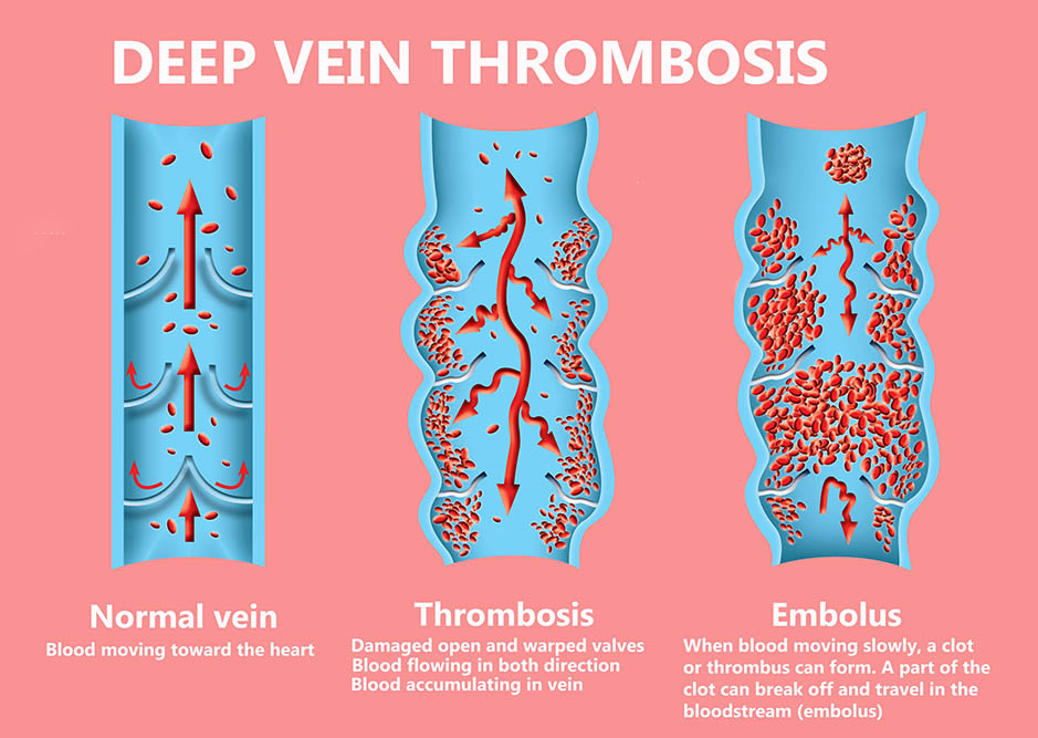 pulmonary embolism illustration